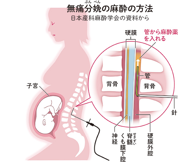 無痛分娩の麻酔の方法